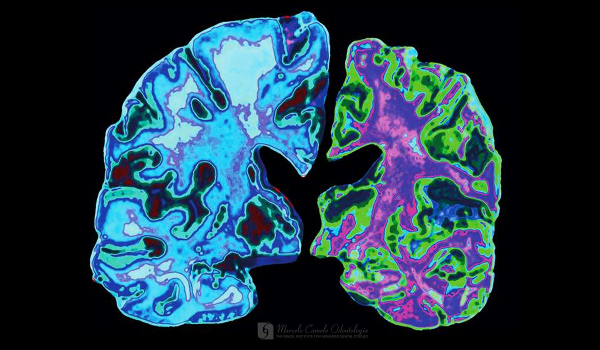 No momento, você está visualizando FINALMENTE, PODEMOS SABER O QUE CAUSA A DOENÇA DE ALZHEIMER E COMO PARÁ-LA