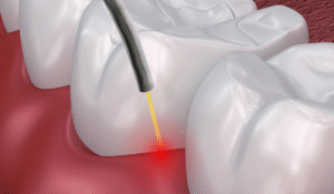 Leia mais sobre o artigo A REVOLUÇÃO EM TRATAMENTOS DE PERIODONTITE E PERIOIMPLANTES