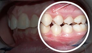 Leia mais sobre o artigo CONTATO ENTRE OS DENTES DAS ARCADAS SUPERIOR E INFERIOR