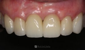 Leia mais sobre o artigo RESTAURAÇÃO SIMULTÂNEA: Óssea, gengival, após fratura da raiz dentária