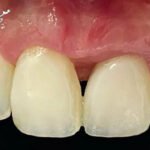 Regeneração de Papilas-III