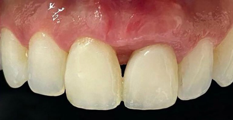 Regeneração de Papilas-III