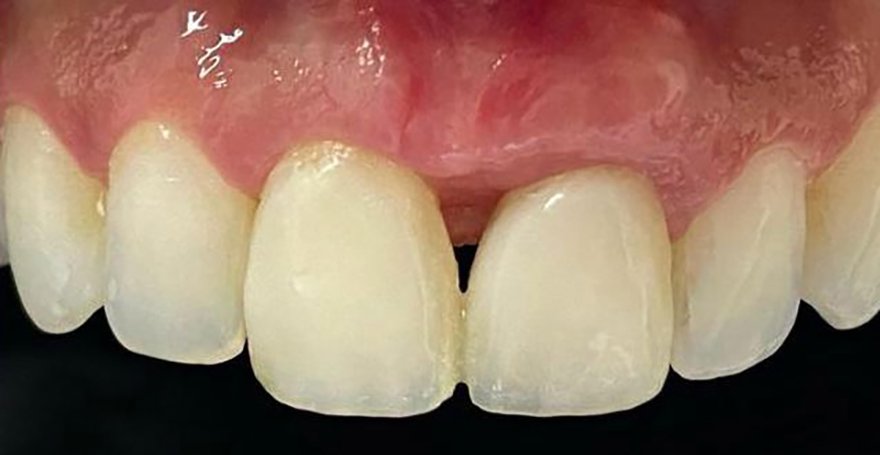 No momento, você está visualizando Regeneração de Papilas-III