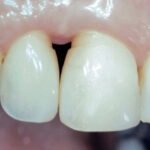 Regeneração de Papilas-II