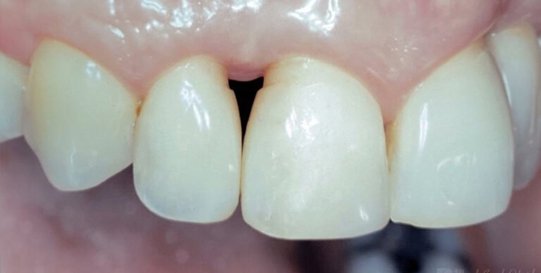 Regeneração de Papilas-II