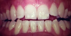 Leia mais sobre o artigo Ajuste Oclusal e Regeneração Periodontal